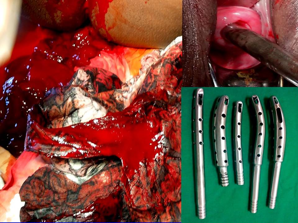 SR Cannula For Recurrent Post CS Bleeding